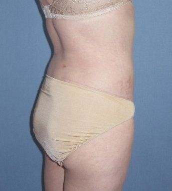 SmartLipo Before And After Photo