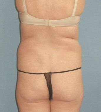 SmartLipo Before And After Photo