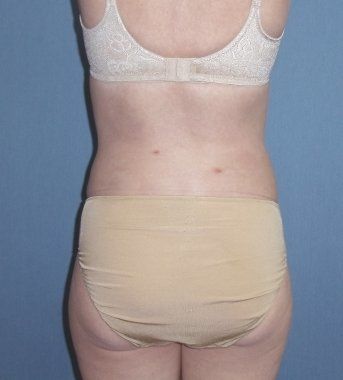 SmartLipo Before And After Photo