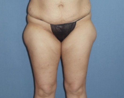 SmartLipo Before And After Photo