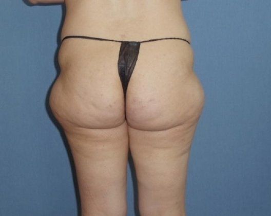 SmartLipo Before And After Photo