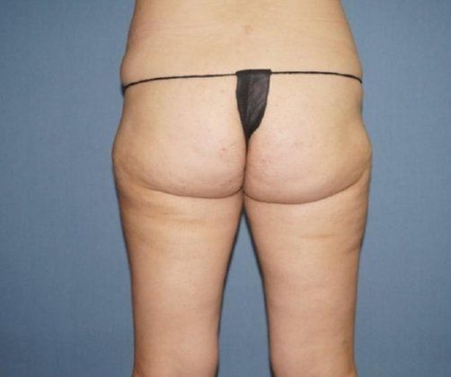 SmartLipo Before And After Photo