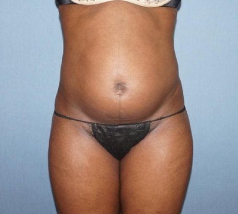 SmartLipo Before And After Photo