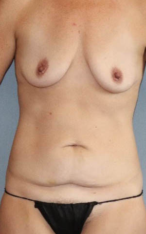 Tummy Tuck Before And After Photo