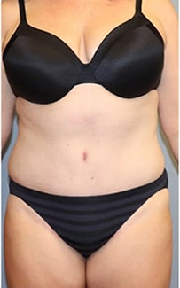 Abdominoplasty Before And After Patient 1