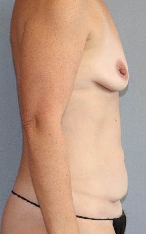 Tummy Tuck Before & After Image