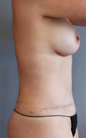 Tummy Tuck Before And After Photo