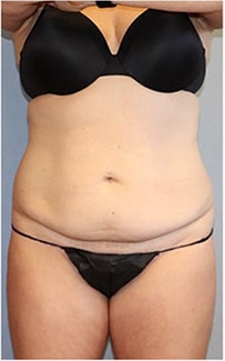 Tummy Tuck Before And After Photo