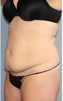 Tummy Tuck Before And After Photo