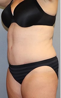 Tummy Tuck Before And After Photo