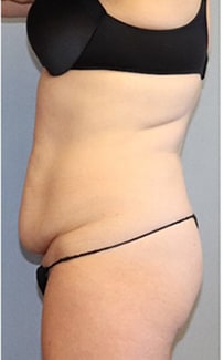 Tummy Tuck Before And After Photo