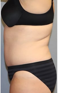 Tummy Tuck Before And After Photo