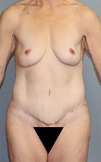Abdominoplasty Before And After Patient 3