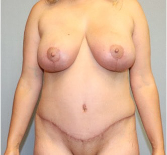 Abdominoplasty Before And After Patient 4