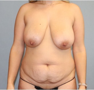 Tummy Tuck Before And After Photo