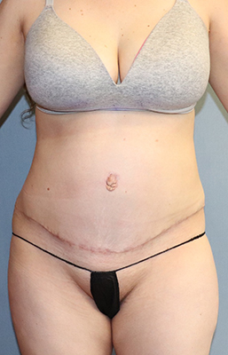Abdominoplasty Before And After Patient 6