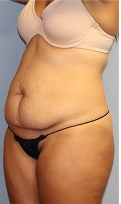 Tummy Tuck Before And After Photo