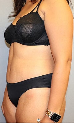 Tummy Tuck Before And After Photo