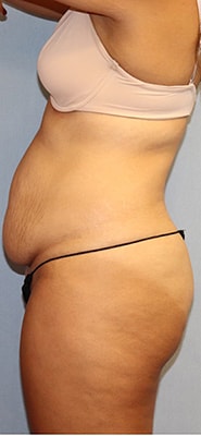 Tummy Tuck Before And After Photo