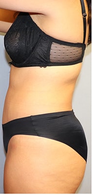 Tummy Tuck Before And After Photo