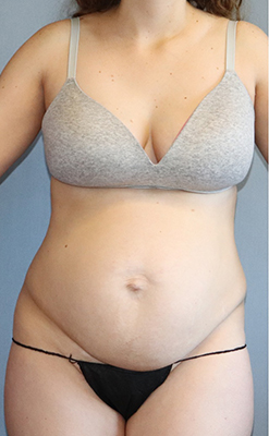 Tummy Tuck Before And After Photo