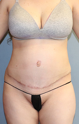 Tummy Tuck Before And After Photo