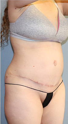 Tummy Tuck Before And After Photo