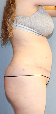 Tummy Tuck Before And After Photo