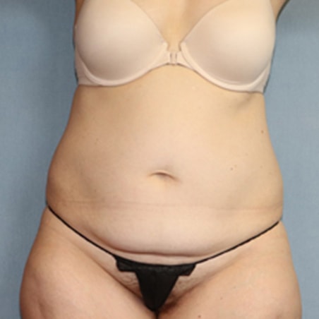 Tummy Tuck Before & After Image