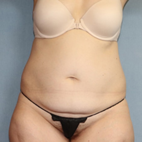 Tummy Tuck Before And After Photo