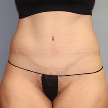 Tummy Tuck Before And After Photo