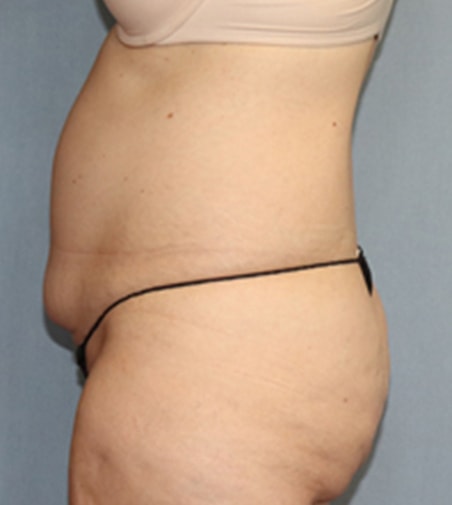 Tummy Tuck Before And After Photo