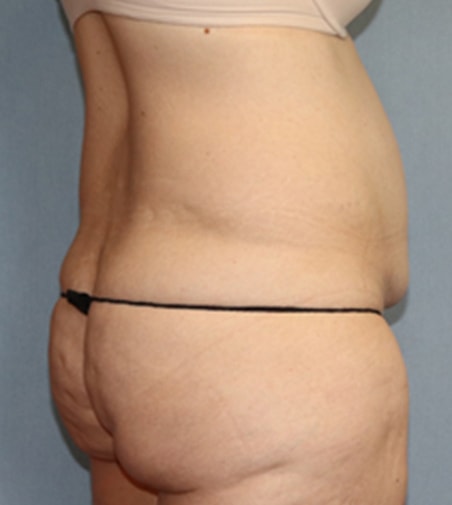 Tummy Tuck Before And After Photo