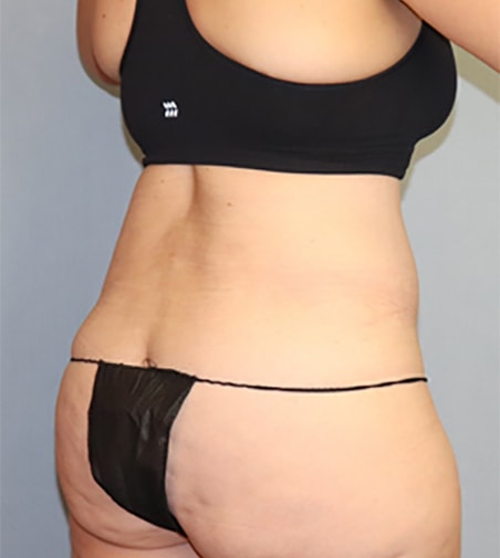 Tummy Tuck Before And After Photo