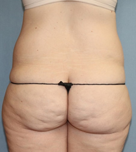Tummy Tuck Before & After Image