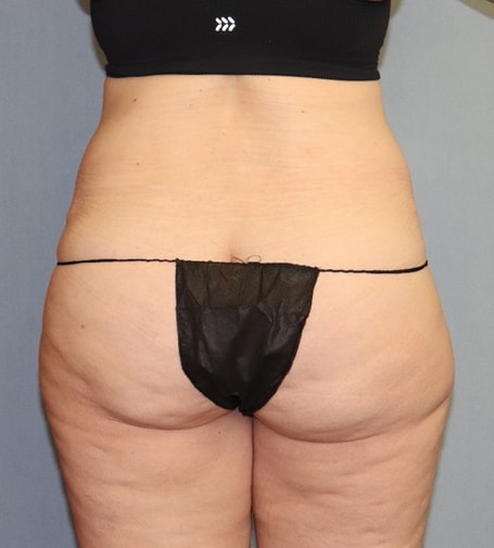 Tummy Tuck Before & After Image
