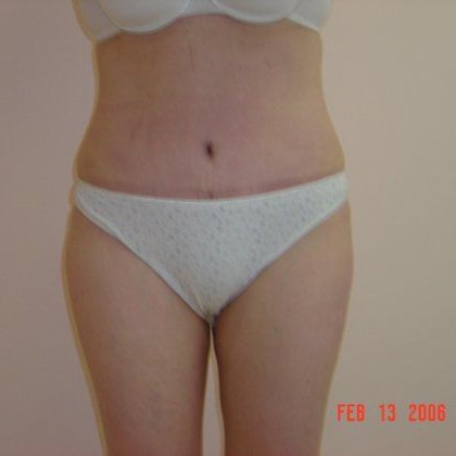 Abdominoplasty Before And After Patient 16
