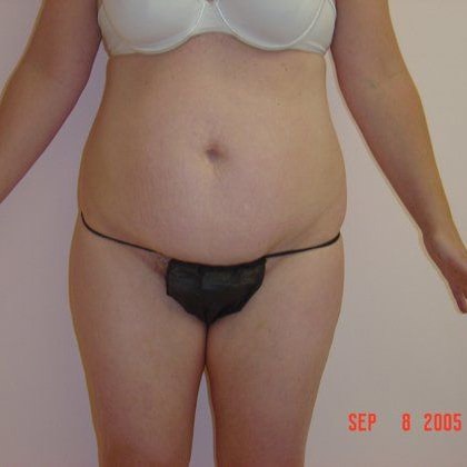 Tummy Tuck Before & After Image