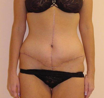 Abdominoplasty Before And After Patient 17