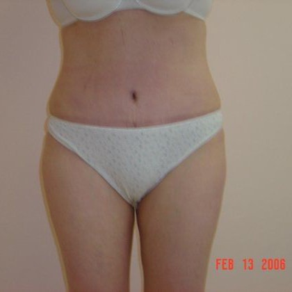 Tummy Tuck Before And After Photo