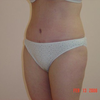 Tummy Tuck Before & After Image