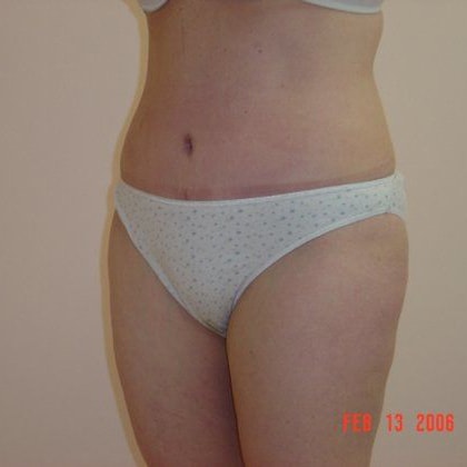 Tummy Tuck Before And After Photo