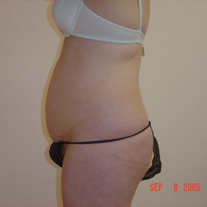 Tummy Tuck Before And After Photo