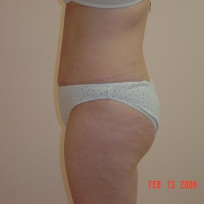 Tummy Tuck Before & After Image