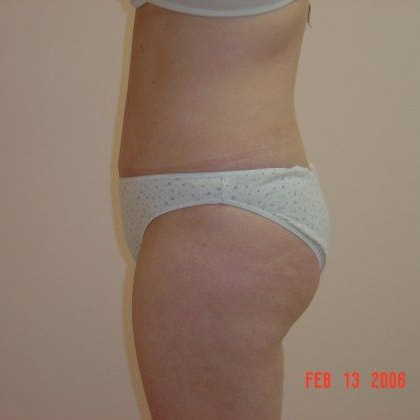 Tummy Tuck Before And After Photo