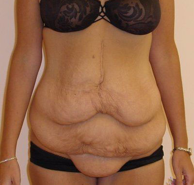 Tummy Tuck Before And After Photo