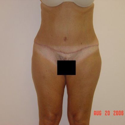 Abdominoplasty Before And After Patient 18