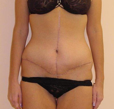 Tummy Tuck Before And After Photo