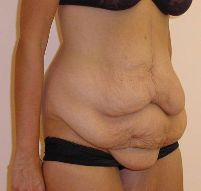 Tummy Tuck Before And After Photo