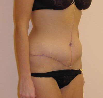 Tummy Tuck Before And After Photo